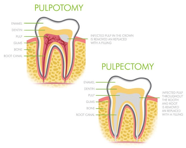 Diagram illustrating the anatomy of a tooth, highlighting the structure and the inner pulp chamber 
